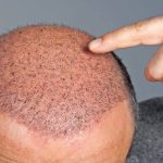 خمیس ‏آبادی خدمات کاشت مو در تهران گیلان غربی