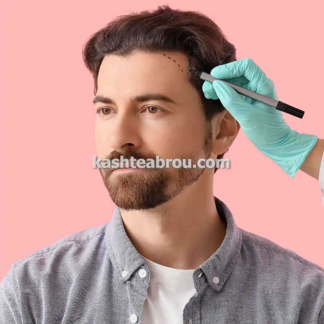 کاشت مو و ابرو طبیعی با تکنیک‌های نوین و قیمت مناسب در تهران