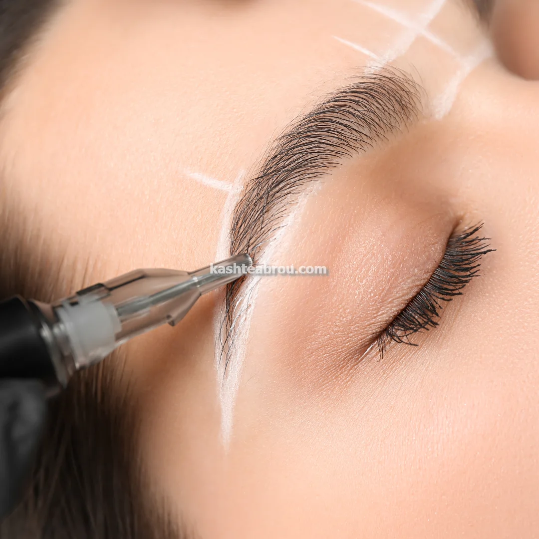 کاشت مو و ابرو طبیعی با تراکم بالا در تهران