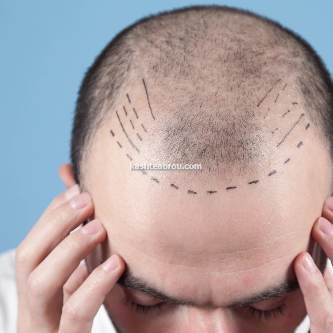 کاشت مو و ابرو طبیعی بدون درد در تهران