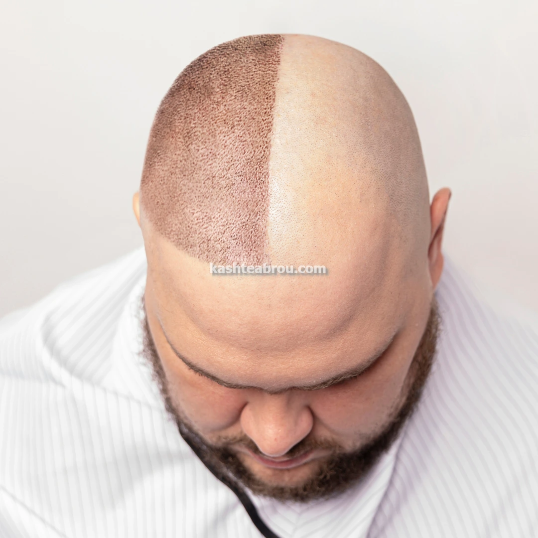 کاشت مو و ابرو طبیعی دائمی در تهران